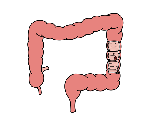 大腸がんとは｜早期発見で治癒が期待できるがん