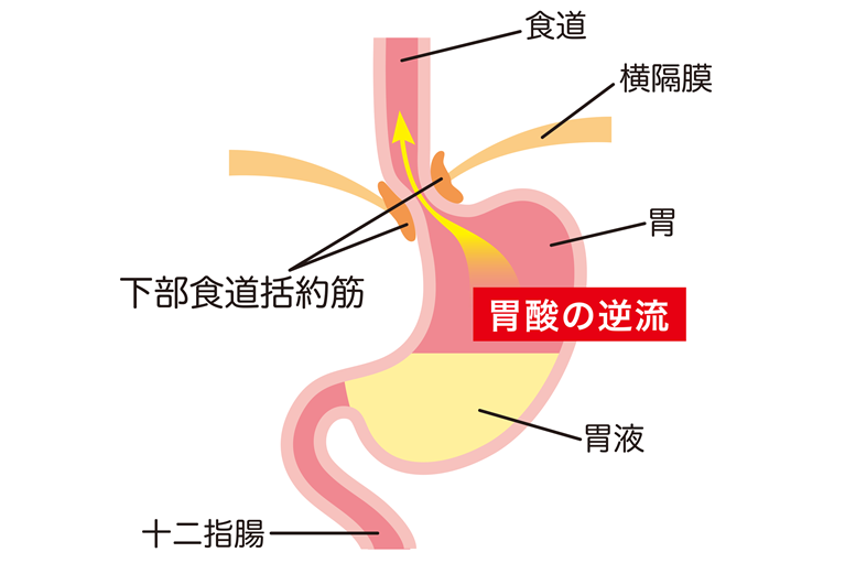 逆流性食道炎とは｜胃酸が食道に逆流する病気