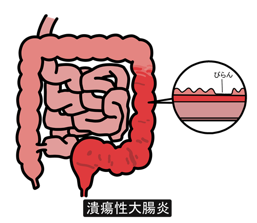 潰瘍性大腸炎とは｜大腸に炎症が続く指定難病